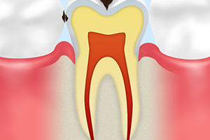 C1　エナメル質の虫歯