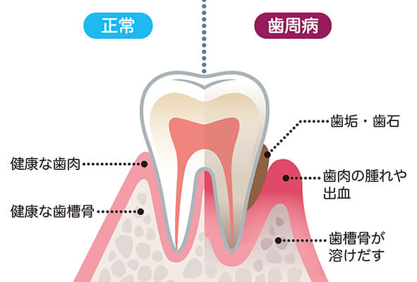 もっとも効果的な歯周病治療はセルフケア