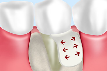 GTR（歯周組織再生誘導法）