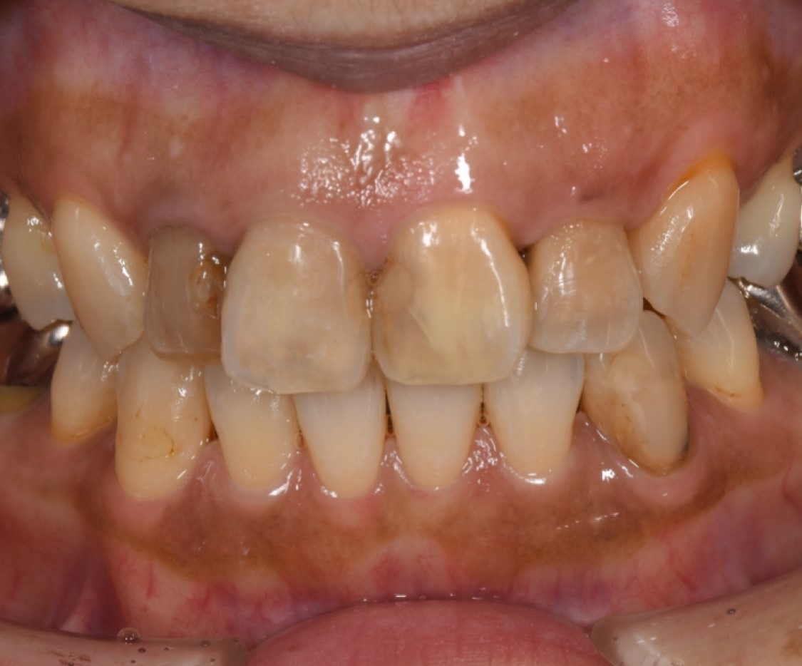 前歯の被せ物（e-max）治療