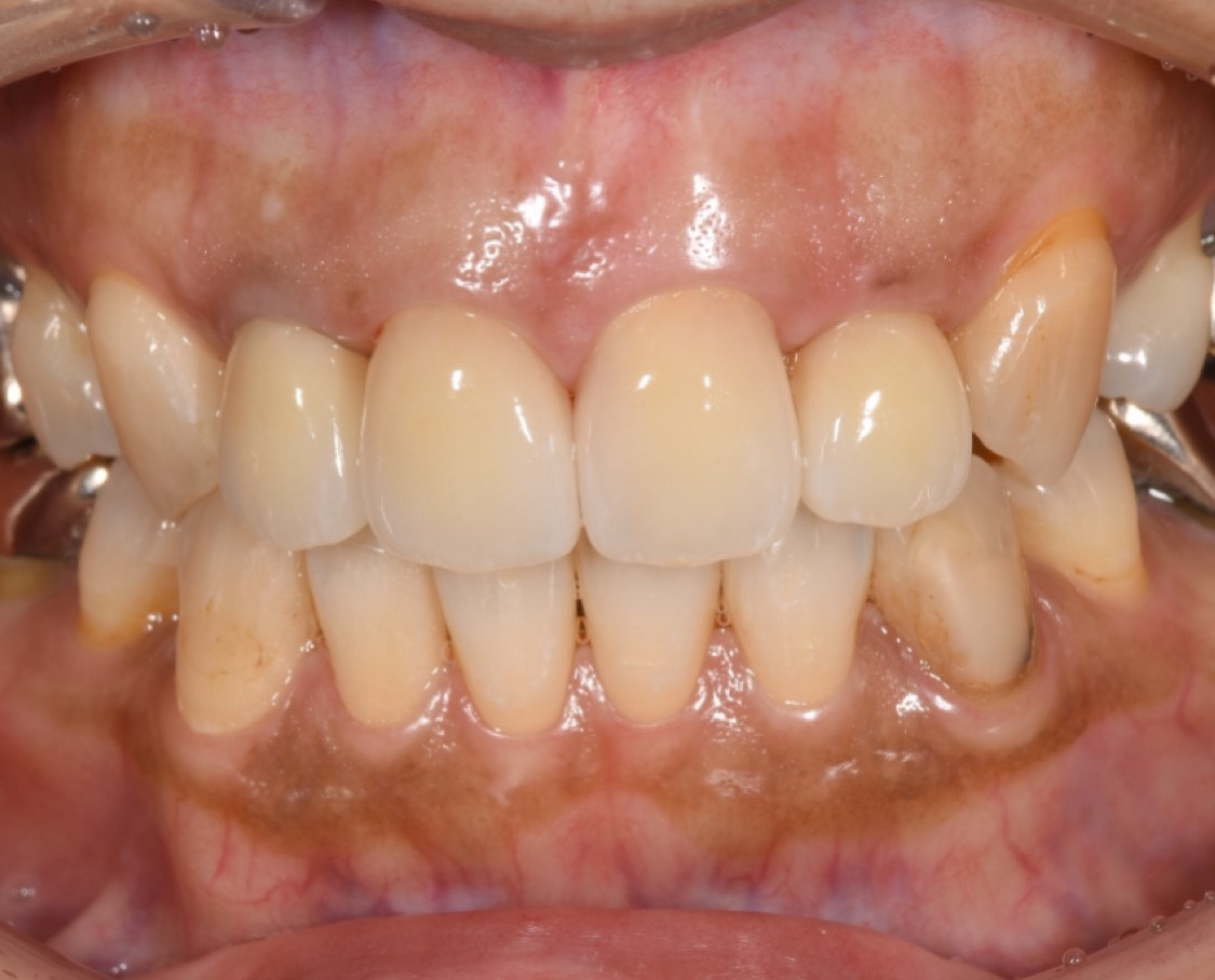前歯の被せ物（e-max）治療