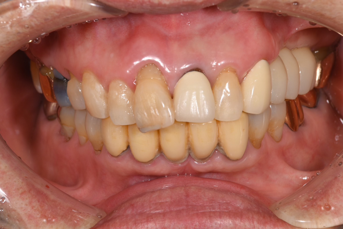 歯のない左上のインプラント治療
