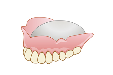 コバルトクロム義歯