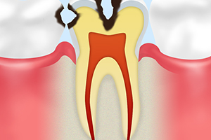 C2　象牙質の虫歯
