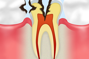 C3　神経に達した虫歯