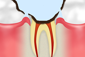 C4　歯根に達した虫歯