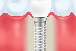 インプラント