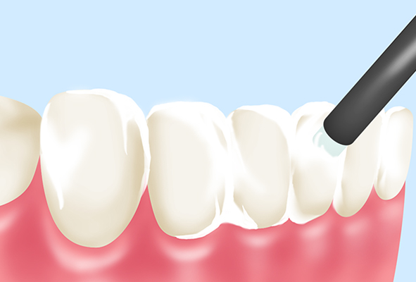 フッ素洗口・塗布