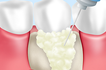 エムドゲイン（歯周組織再生療法）