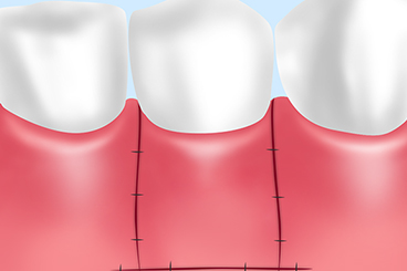 FGG（遊離歯肉移植術）