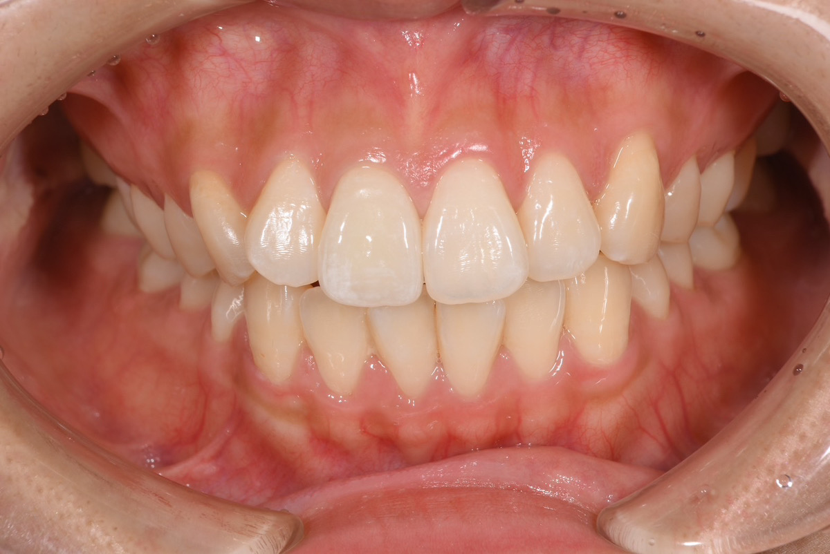 e-maxクラウンで前歯の色を治療