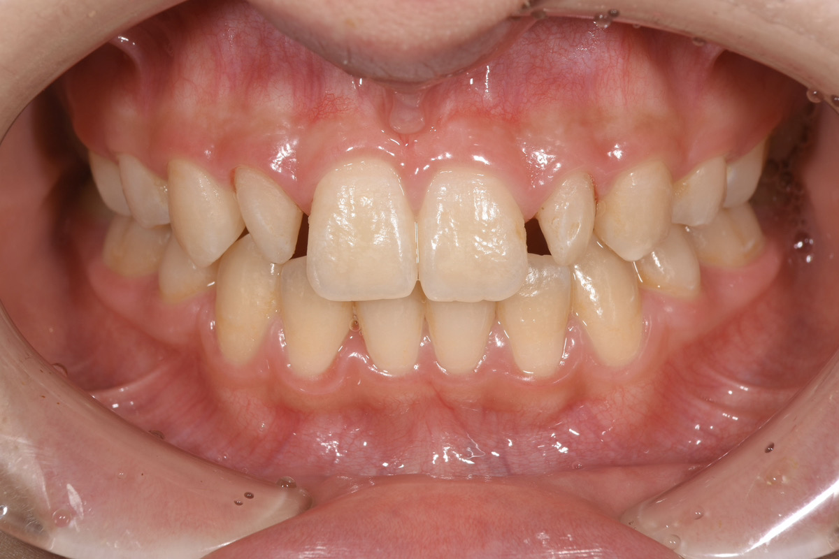 ラミネートベニヤで前歯の治療