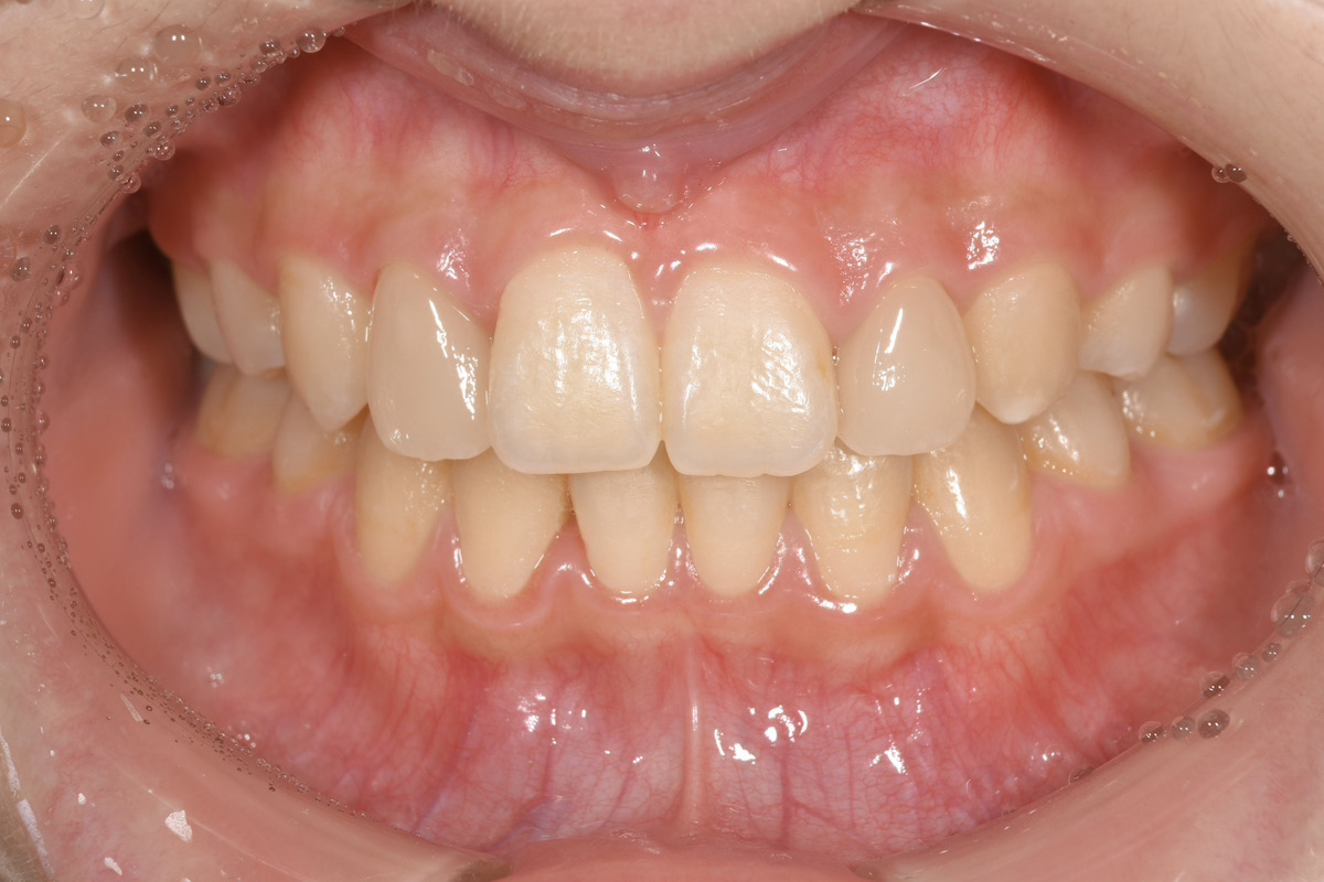 ラミネートベニヤで前歯の治療