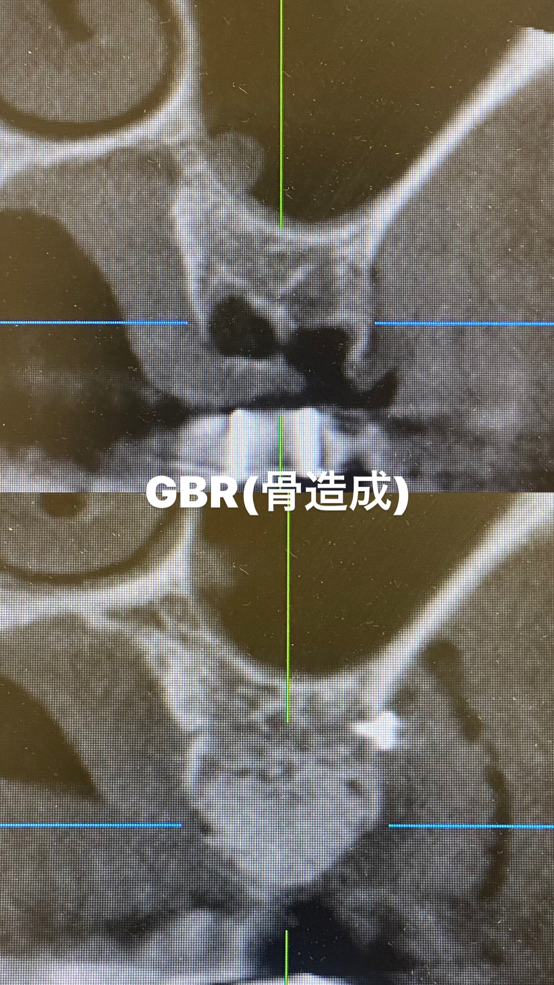 骨造成(GBR)について