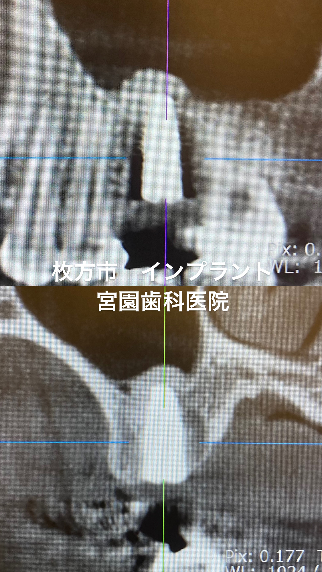 インプラント治療時の骨造成