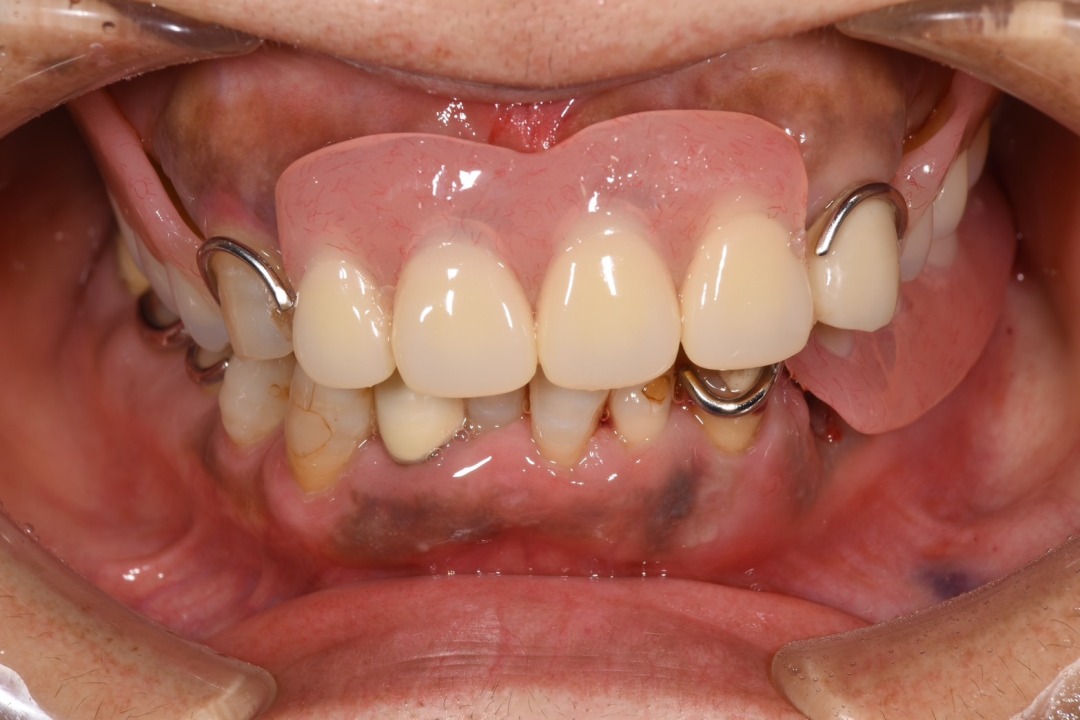 抜歯当日に入れ歯が入る治療(即時義歯)