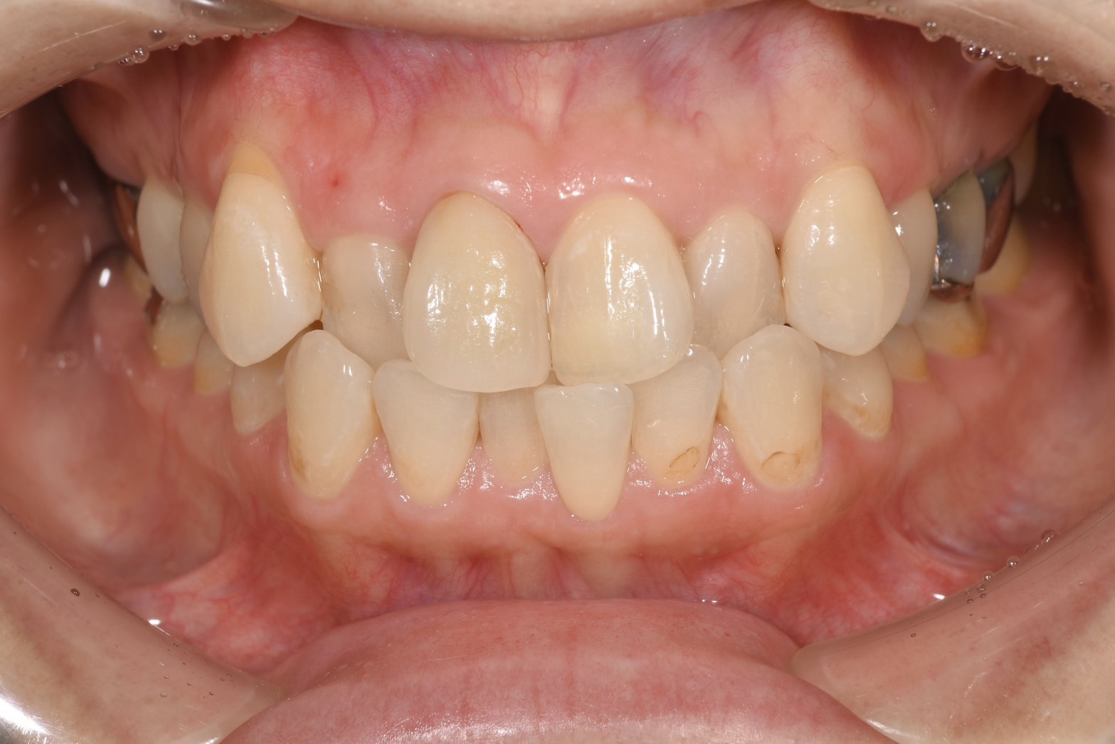 前歯の変色でお悩みの患者様の治療