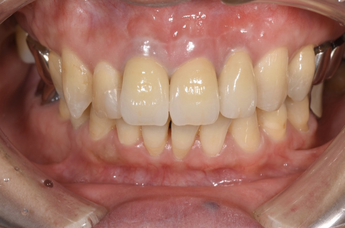 根管治療と歯根端切除術について