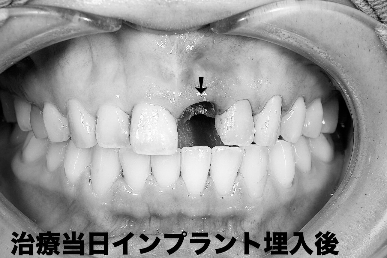 前歯のインプラント抜歯即時埋入