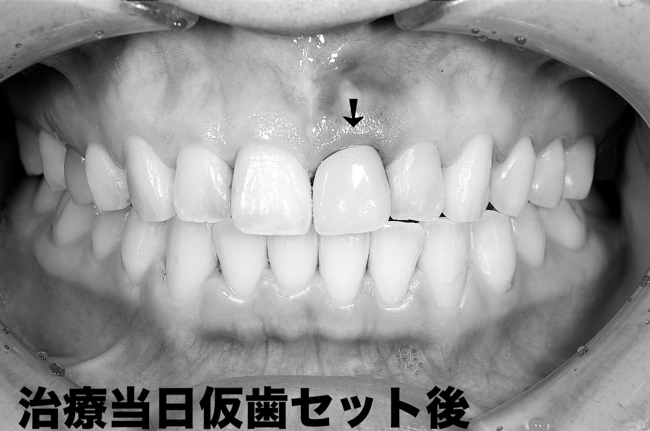 前歯のインプラント抜歯即時埋入
