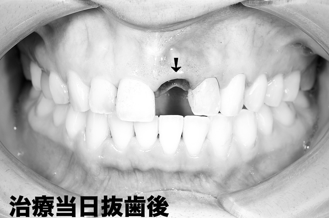 前歯のインプラント抜歯即時埋入