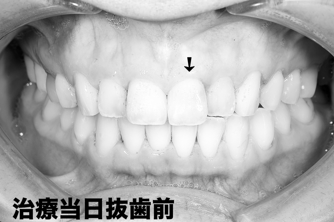 前歯のインプラント抜歯即時埋入