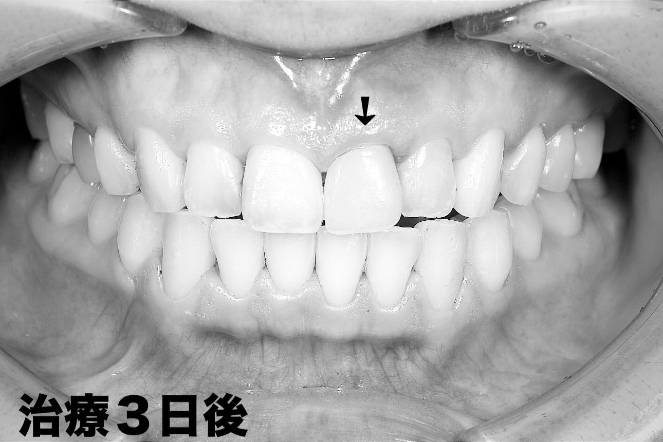 前歯のインプラント抜歯即時埋入