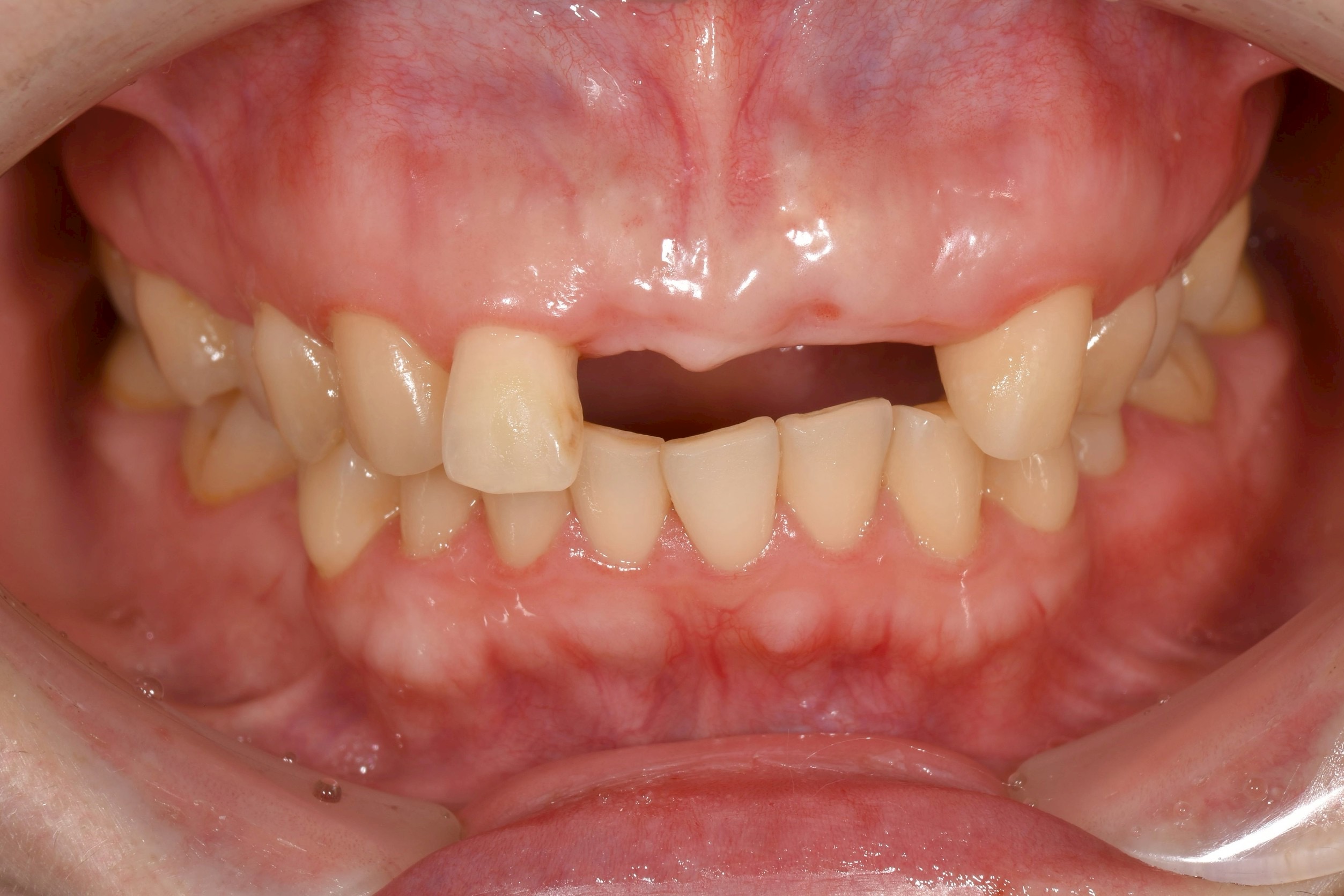 折れた前歯3本をインプラントで治療