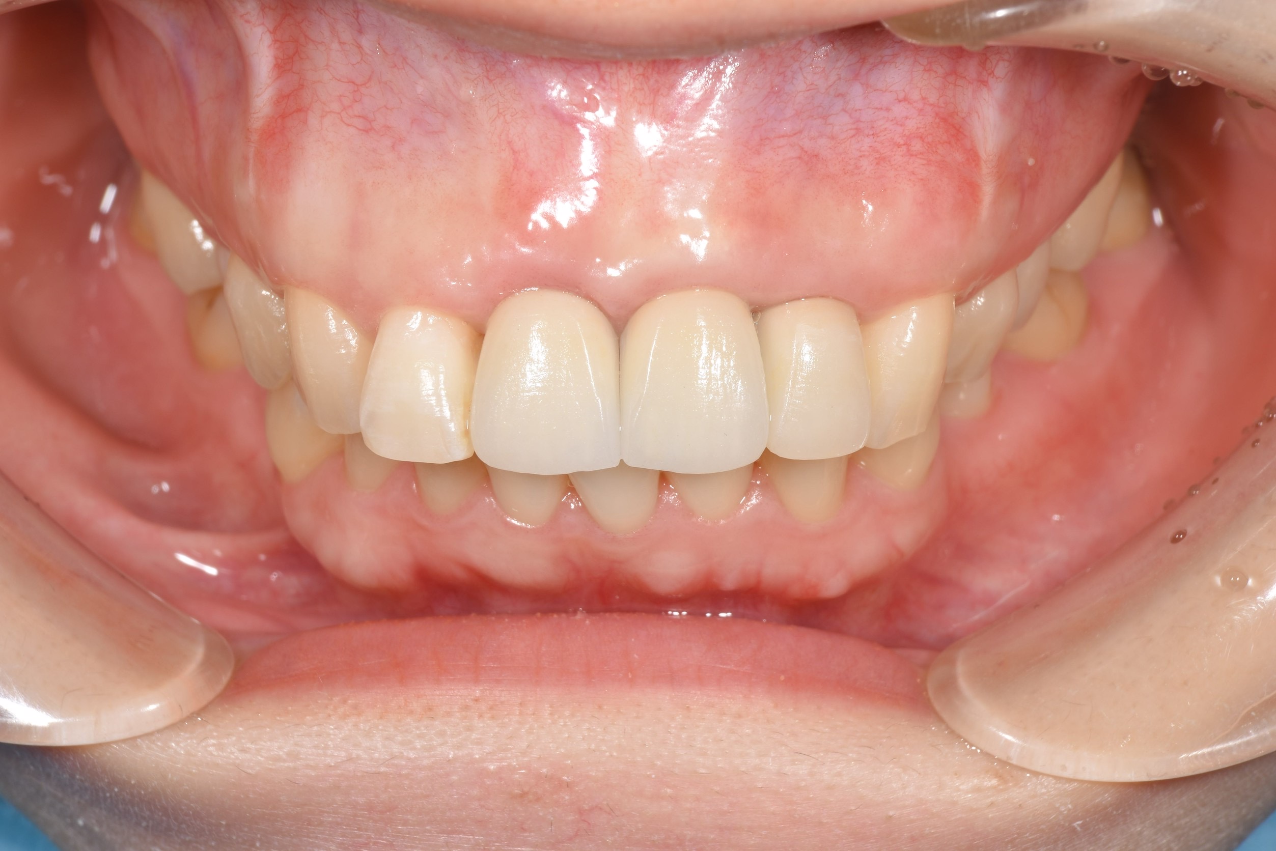 折れた前歯3本をインプラントで治療