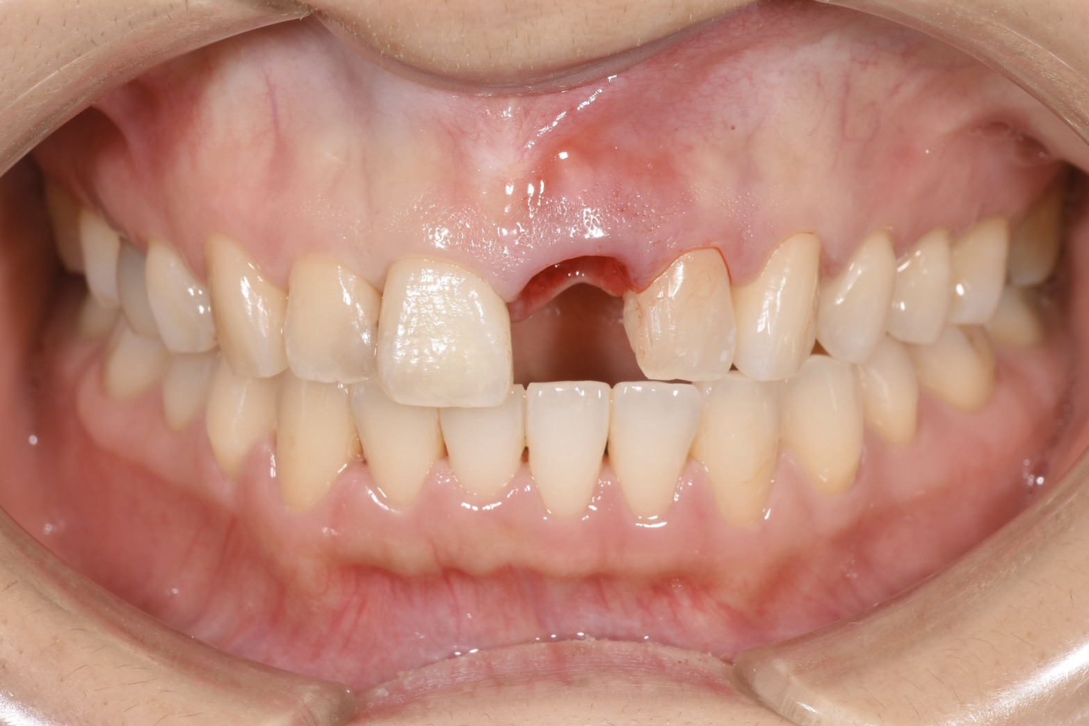 前歯のインプラント抜歯即時埋入