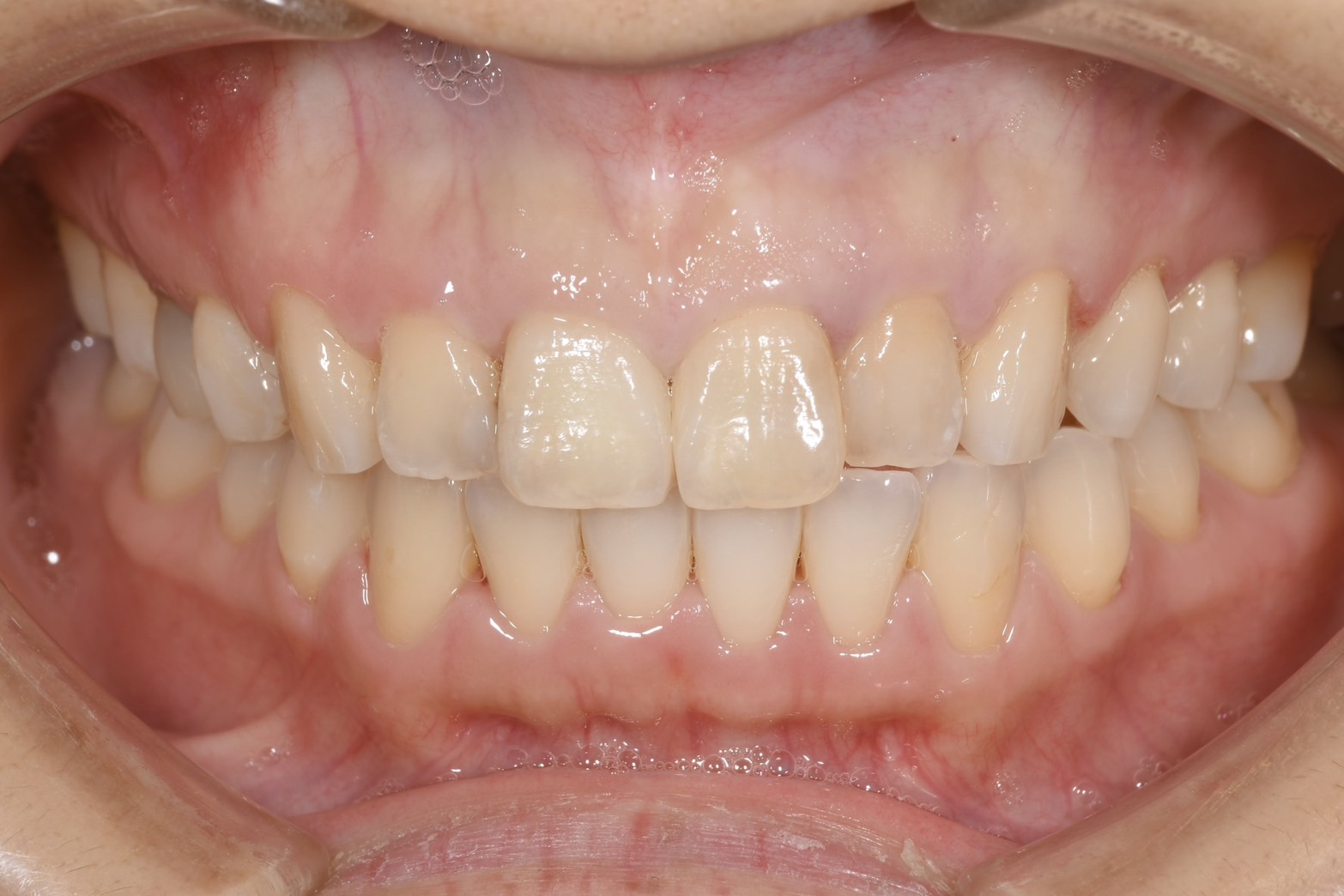 前歯のインプラント抜歯即時埋入