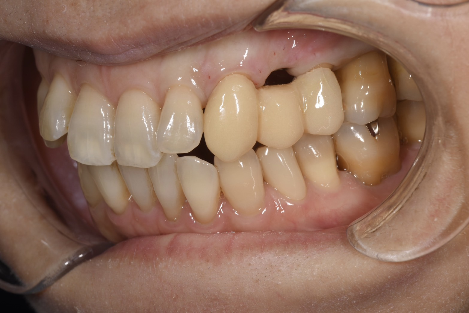 ブリッジからインプラントに