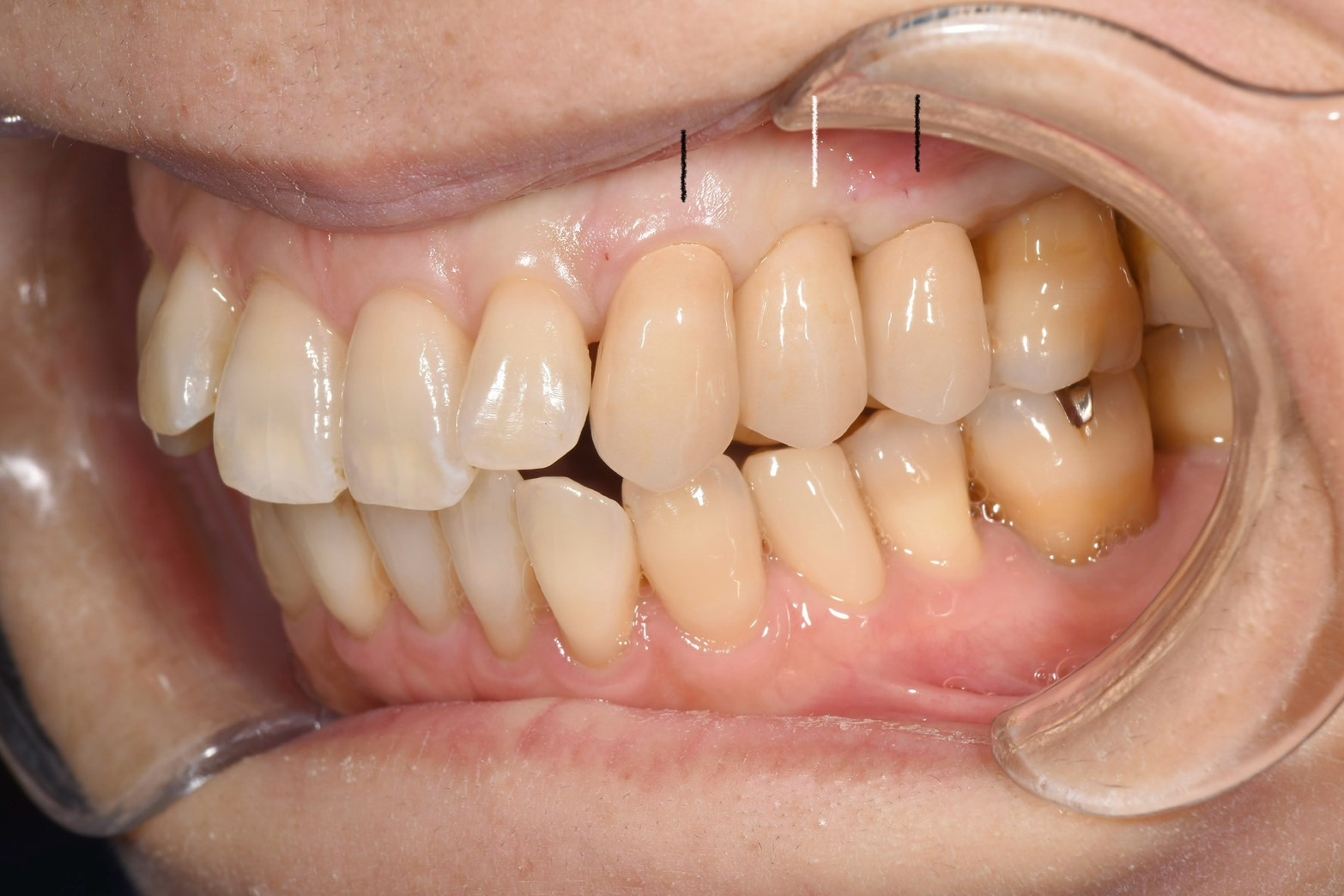 ブリッジからインプラントに