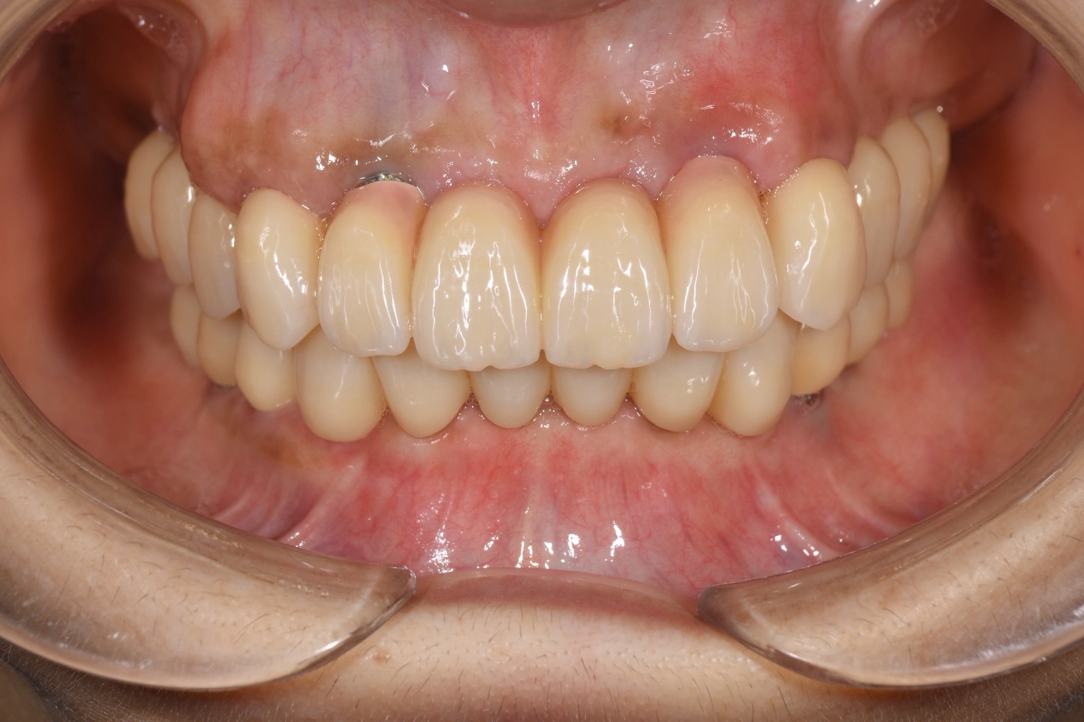 上顎オールオン6下顎オールオン4