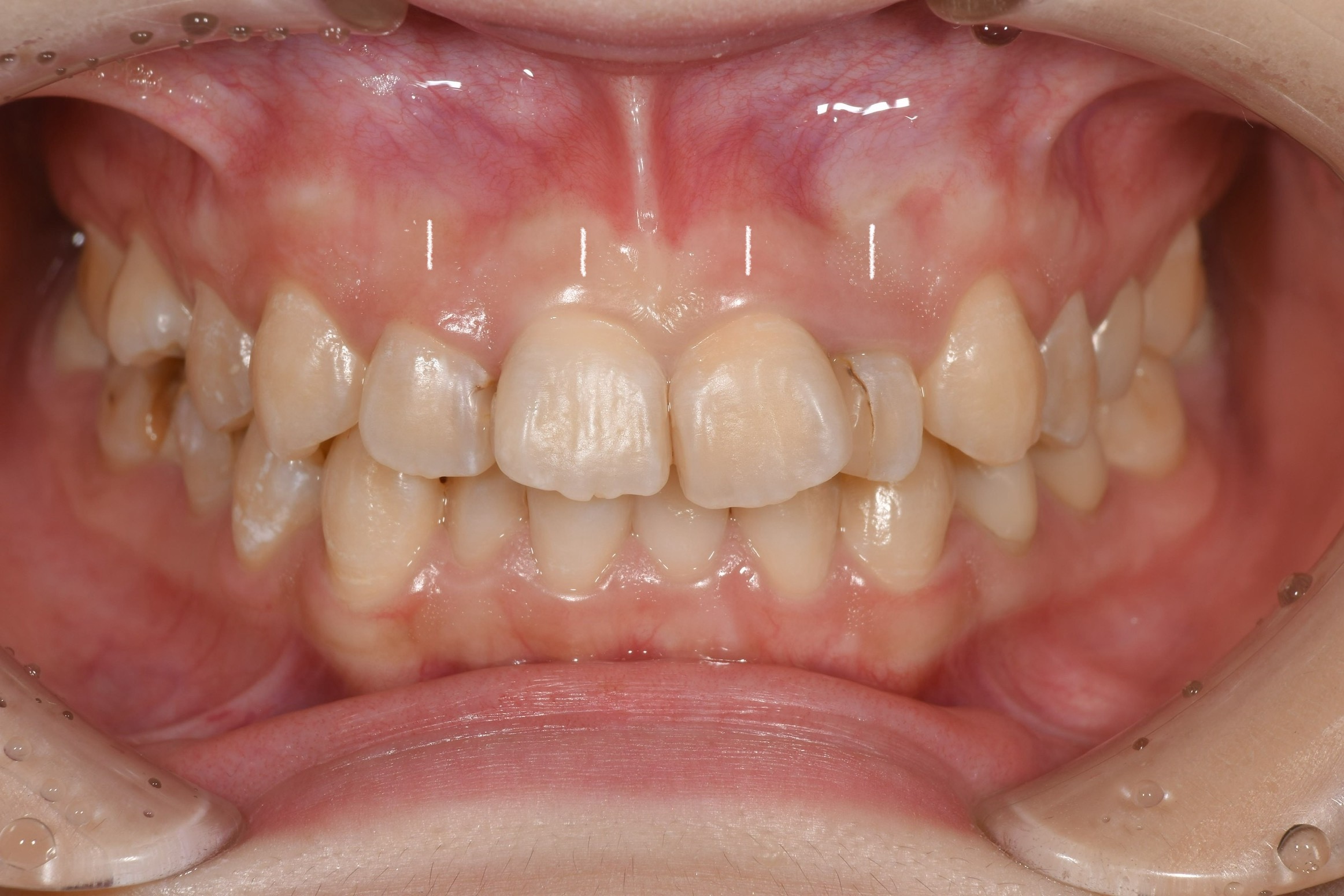 前歯四本の被せ物治療