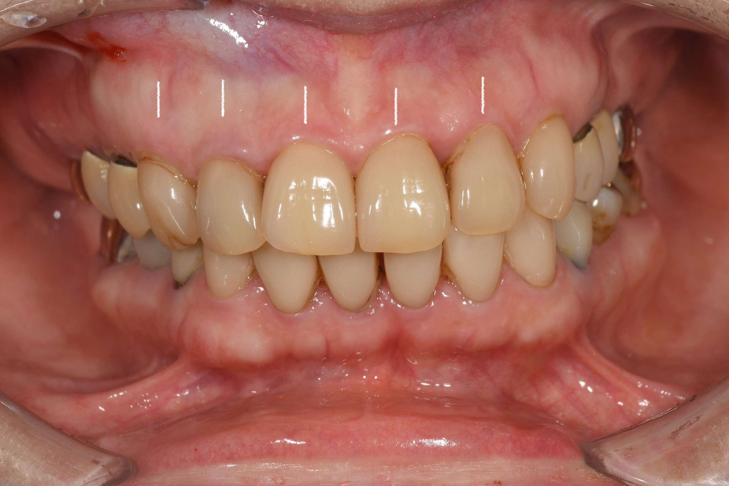 前歯五本の被せ物治療