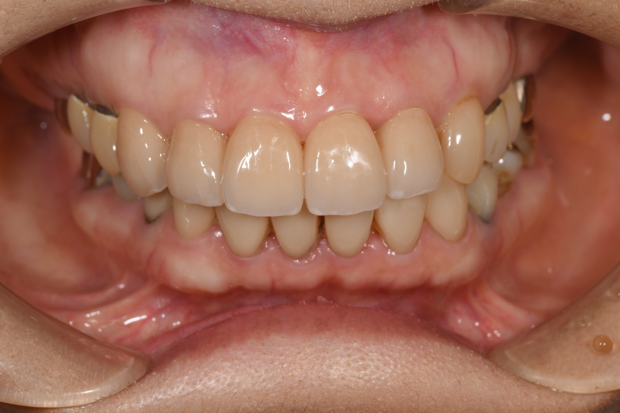 前歯五本の被せ物治療