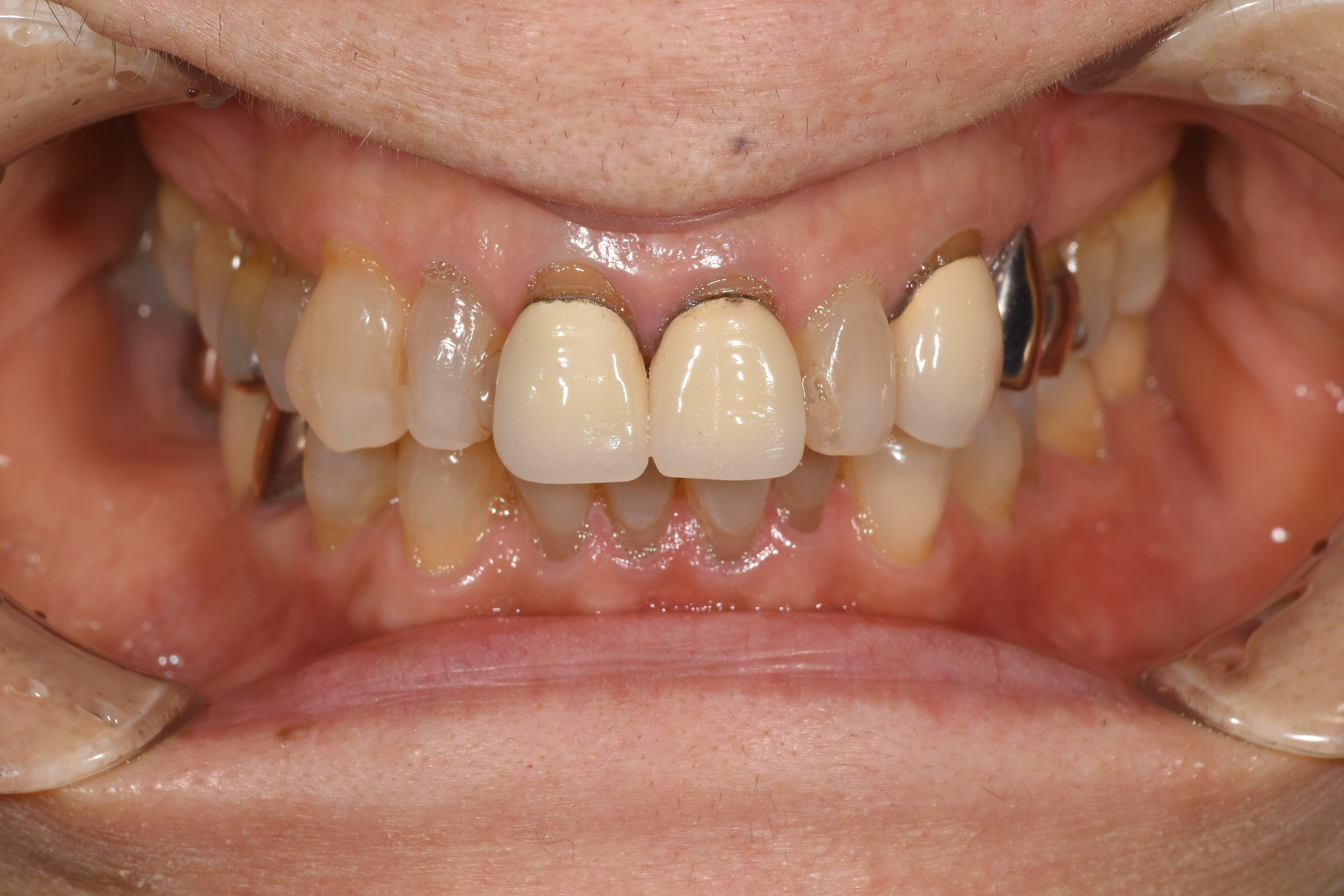 前歯二本の被せ物治療