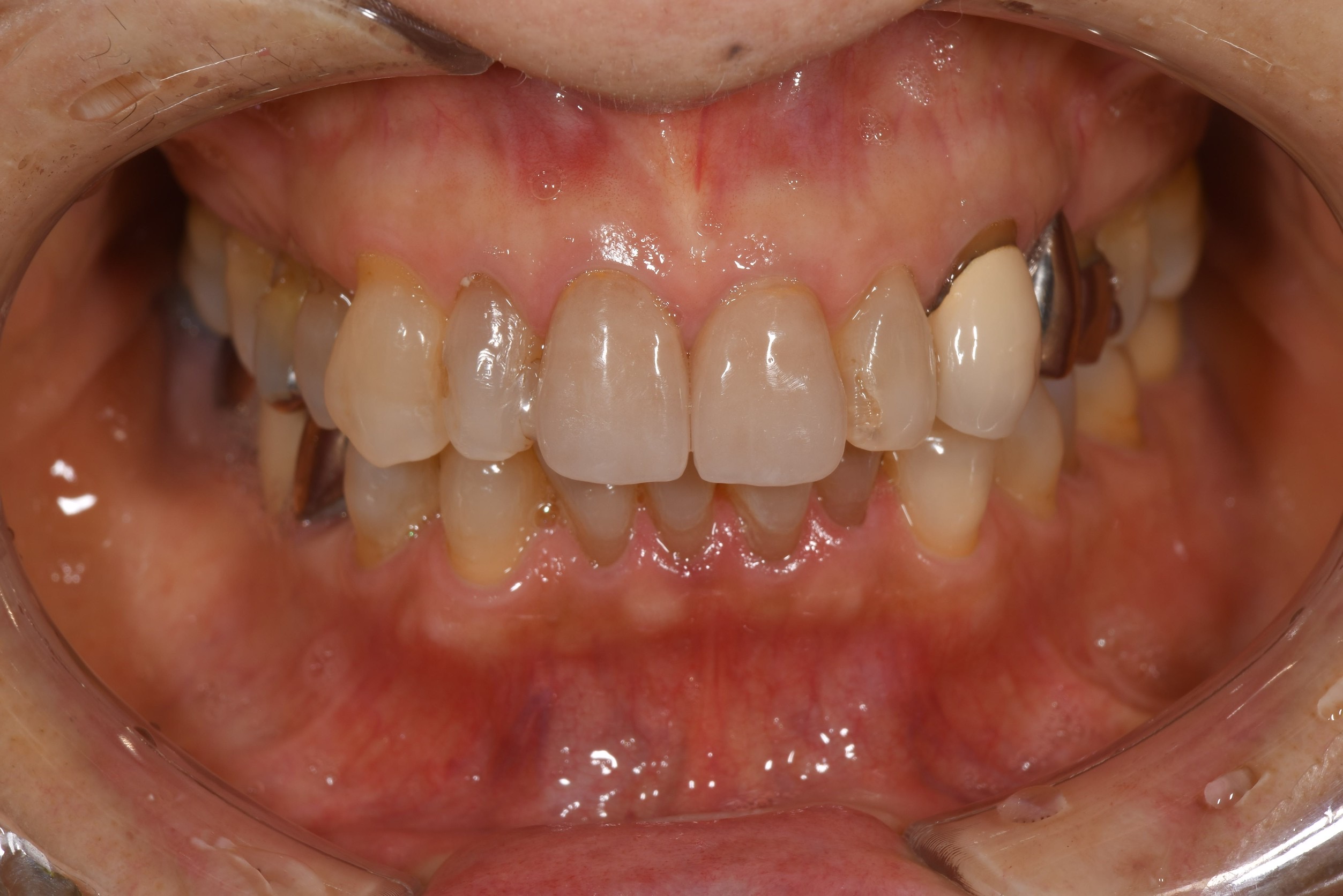 前歯二本の被せ物治療